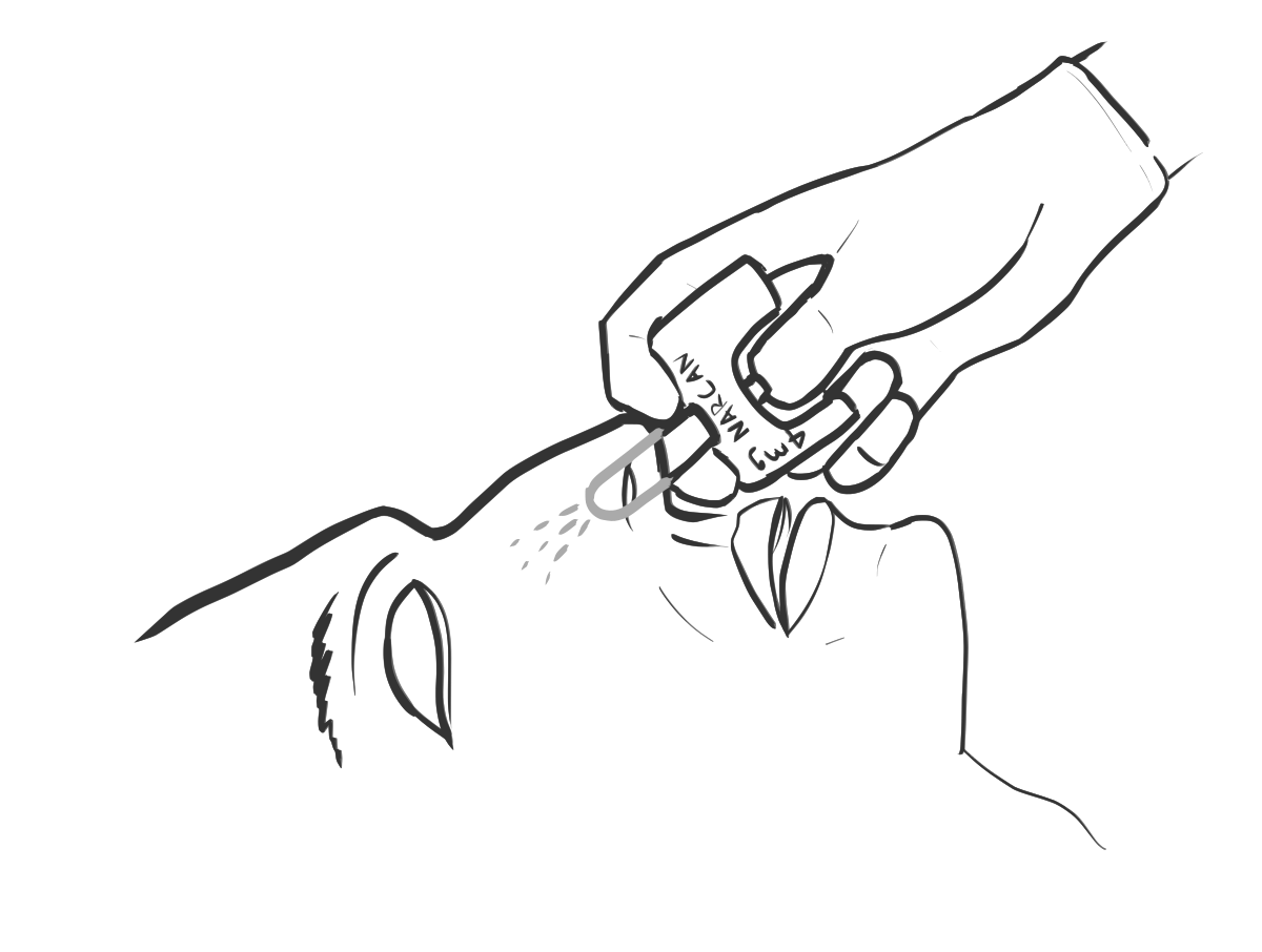 A drawing of a person administering nasal naloxone spray into someone's nose. 