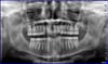 Panoramic dental x-ray of an adult male without third molars